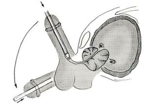 Endoskopisches Operationsschema zur Penisvergrößerung