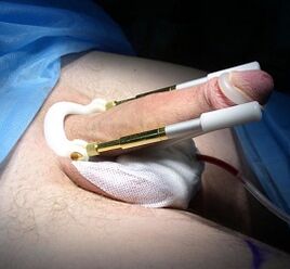 Wie eine Operation durchgeführt wird, um den Penis zu erhöhen
